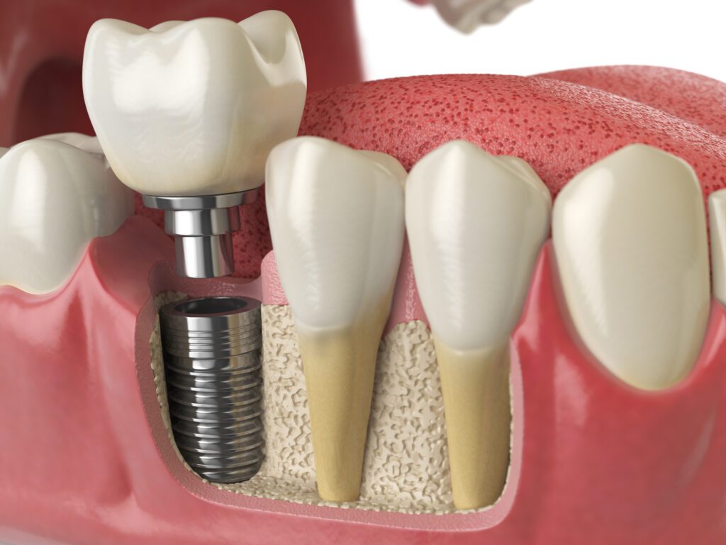 Dental Implants in Arlington, TX